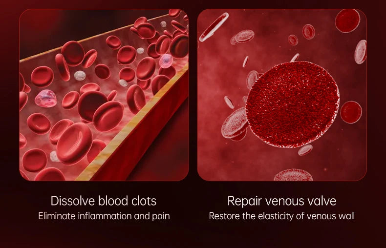 Creme Eficaz Varizes - Alívio Vasculite Flebite Pernas Pés Capilares