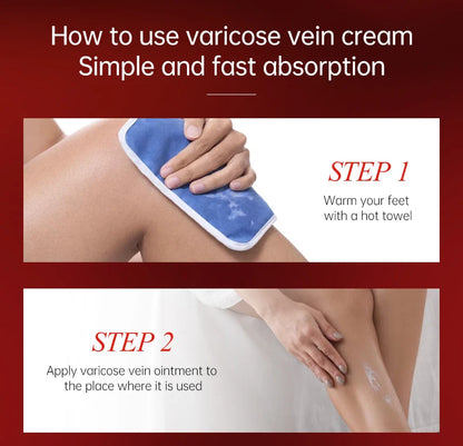 Creme Eficaz Varizes - Alívio Vasculite Flebite Pernas Pés Capilares