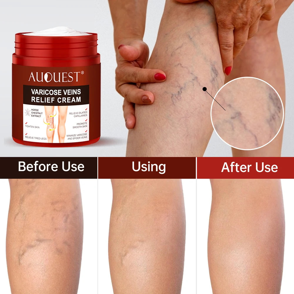 Creme Eficaz Varizes - Alívio Vasculite Flebite Pernas Pés Capilares